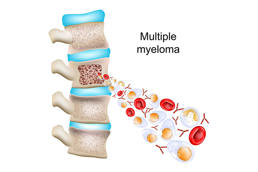 Multiple myeloma. Part of a Vertebral column with cross section of a vertebra with bone structure and bone marrow. Close-up of Abnormal plasma cells, red blood cells, and antibodies.